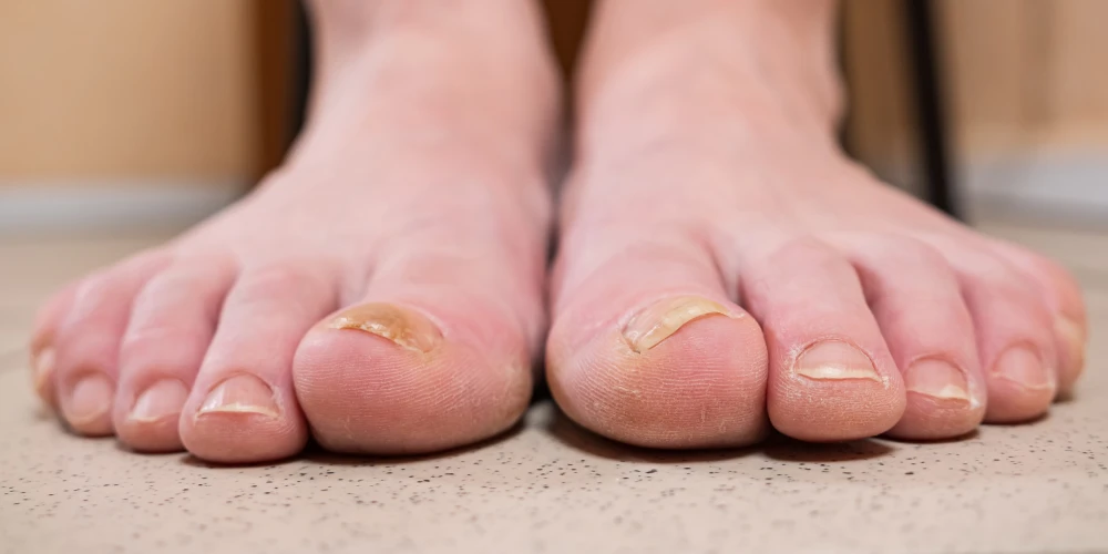 פטרת ציפורניים תמרור אזהרה