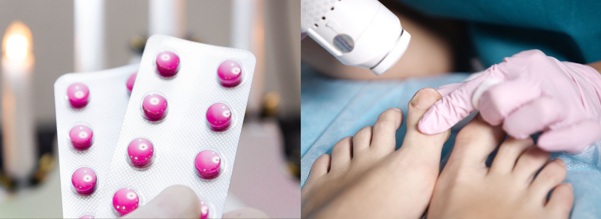 טיפול בפטרת בלייזר או בכדורים